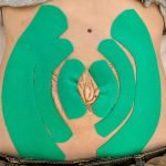 Frau nach Schwangerschaft mit Rektusdiastase und Kinesio-Taping in grün